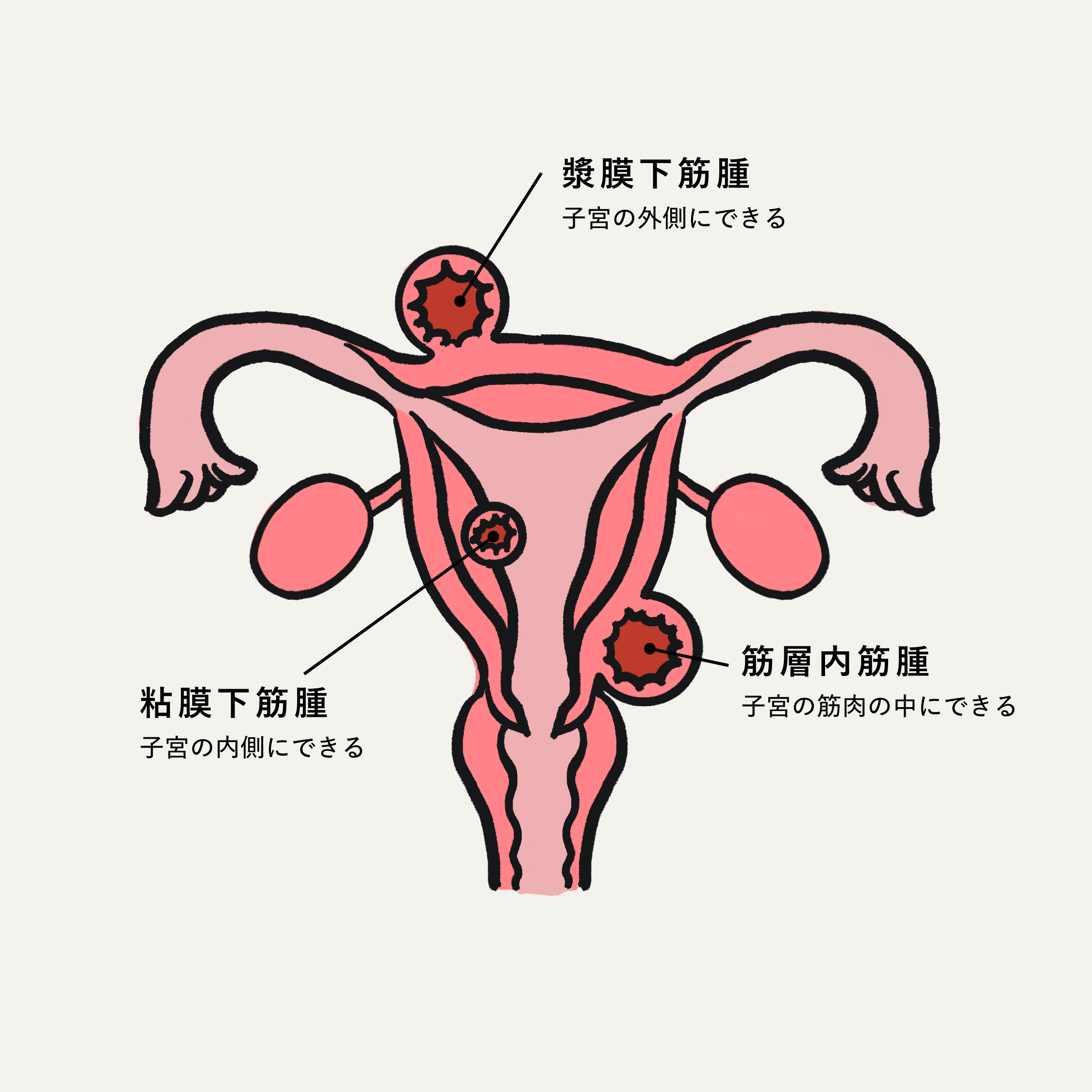 子宮筋腫の種類を示す図解（漿膜下筋腫・粘膜下筋腫・筋層内筋腫）